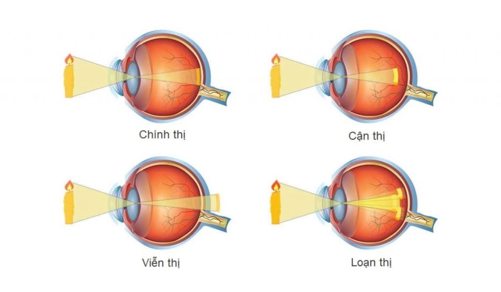 Các loại tật khúc xạ phổ biến gồm: cận thị, viễn thị, loạn thị và lão thị