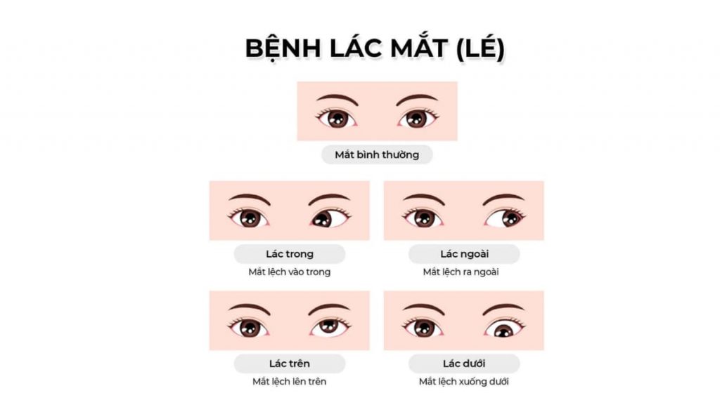 Mắt lác trong là tình trạng một mắt lệch hướng vào trong, làm mất cân đối