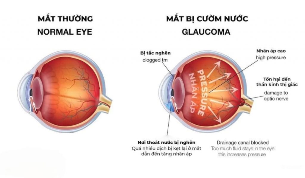 Mổ mắt cườm nước là phẫu thuật giảm áp lực mắt để điều trị bệnh glôcôm