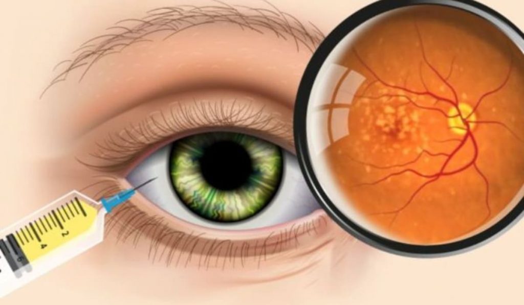 Phương pháp tiêm nội nhãn là kỹ thuật bơm thuốc trực tiếp vào mắt để điều trị