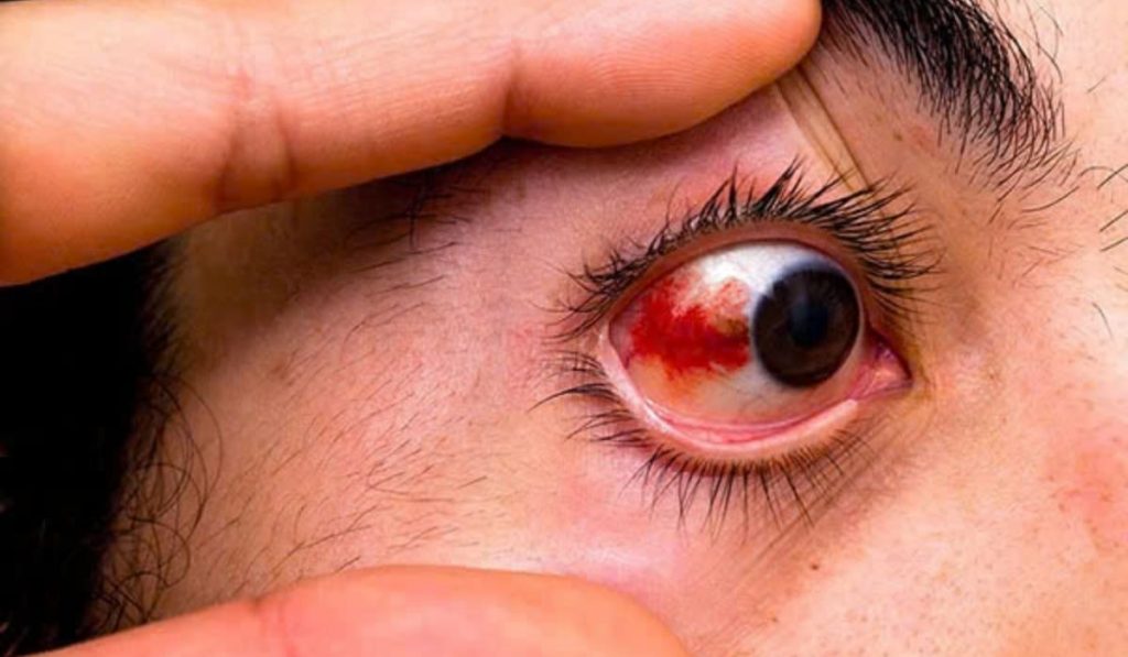 Cận thị có thể gây biến chứng nghiêm trọng như bong võng mạc ảnh hưởng lâu dài đến thị lực