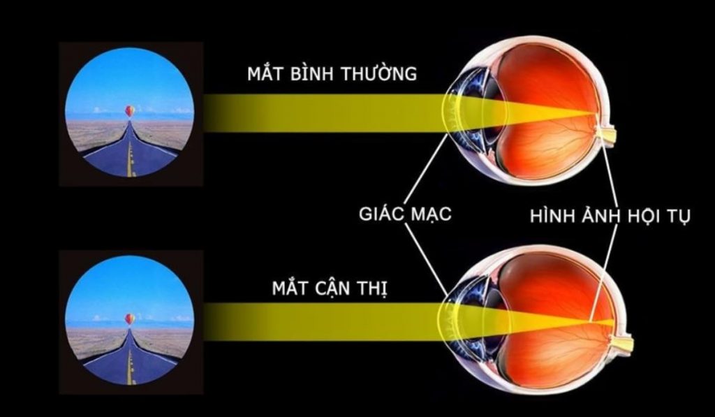 Cận thị là khi ánh sáng hội tụ trước võng mạc, khiến vật ở xa mờ nhòe