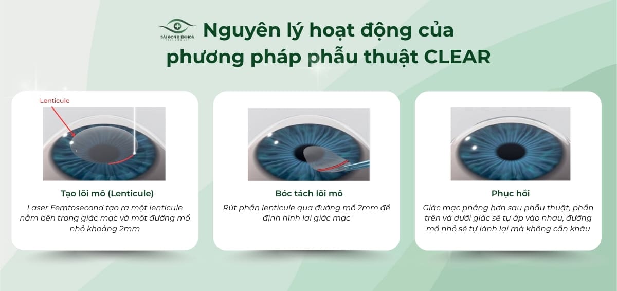 Nguyên lý hoạt động của phẫu thuật CLEAR