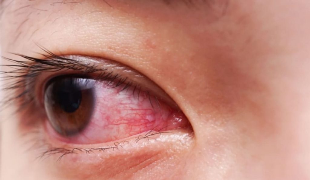 Bệnh đau mắt đỏ có thể lây lan trong cộng đồng nếu không phòng ngừa đúng cách
