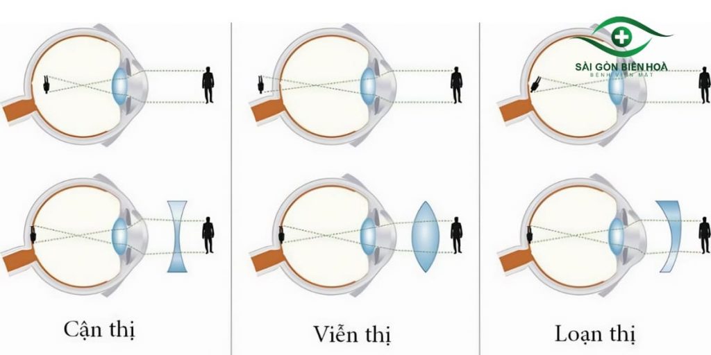 Các tật khúc xạ khiến hình ảnh của vật không hiển thị đúng trên võng mạc