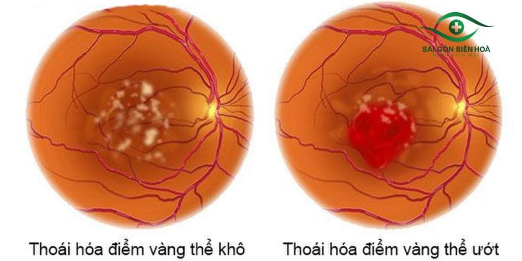 Cận thị nặng có thể gây biến chứng thoái hóa điểm vàng