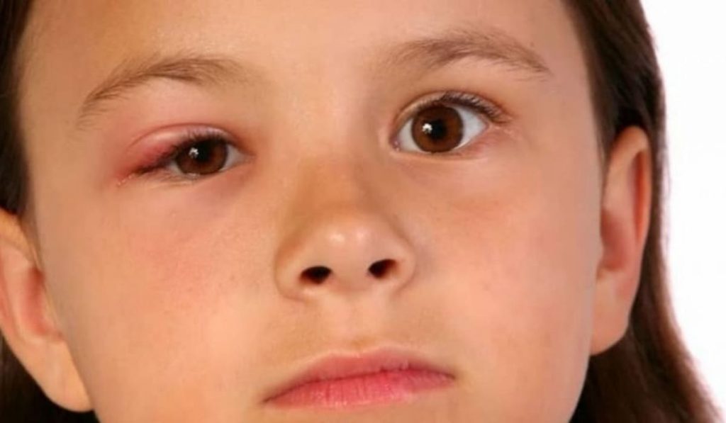 Chăm sóc và vệ sinh mắt đúng cách là việc quan trọng để giúp lẹo mau xẹp
