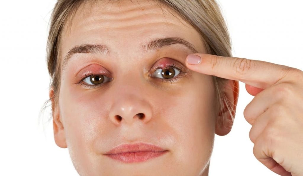 Chữa lẹo mắt bằng nước bọt có thể dẫn đến bị nhiễm trùng