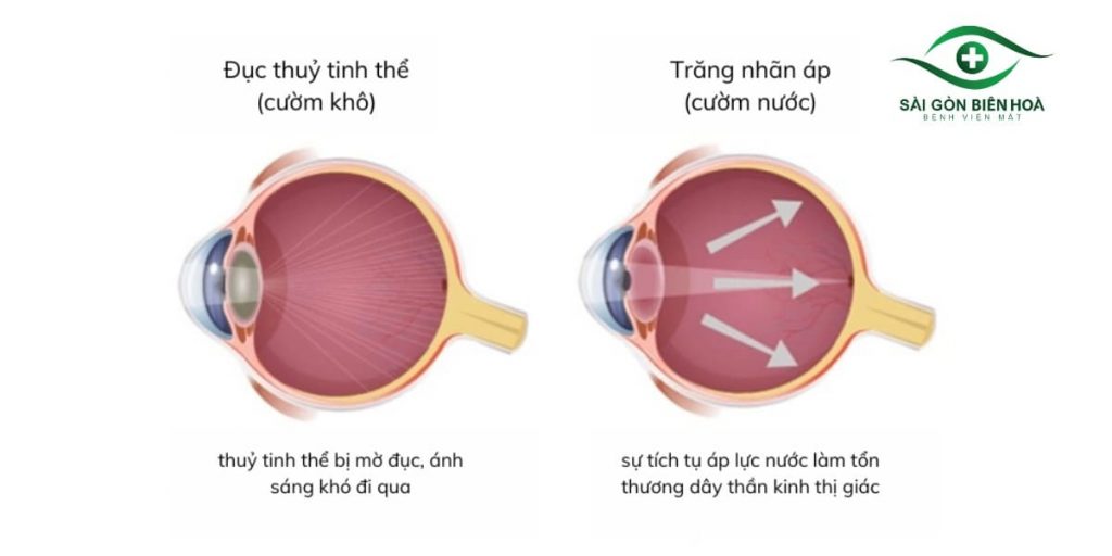 Cườm nước gây mất thị lực không hồi phục