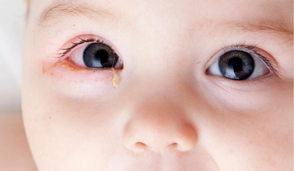 Đau mắt đỏ kèm sốt, đưa bé đi khám bác sĩ ngay để xử lý kịp thời