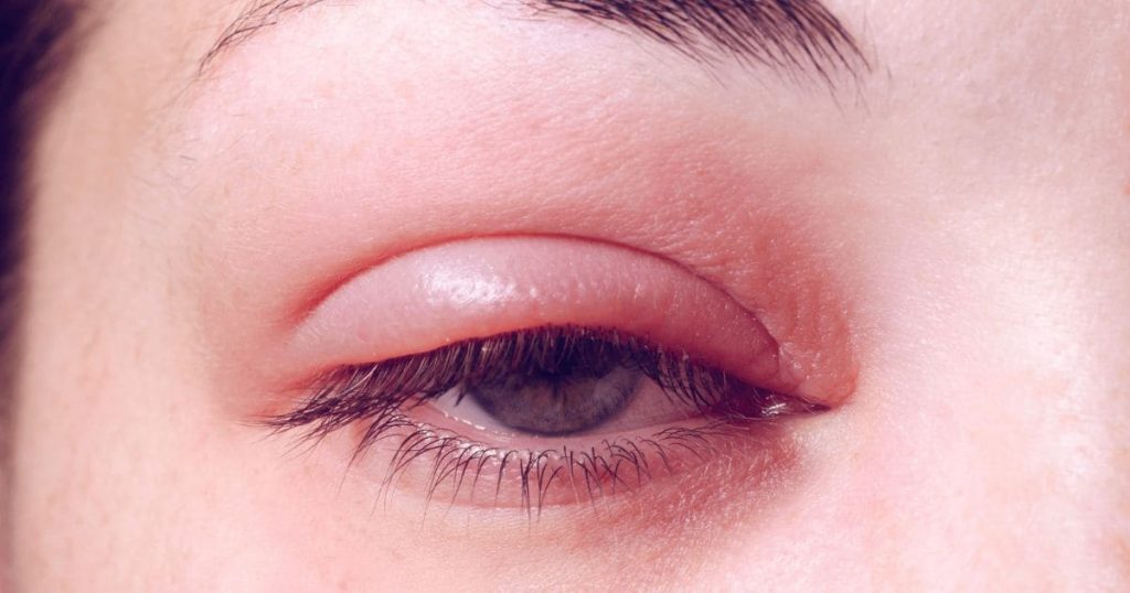 Đôi khi mắt bị mờ là triệu chứng của viêm nhiễm