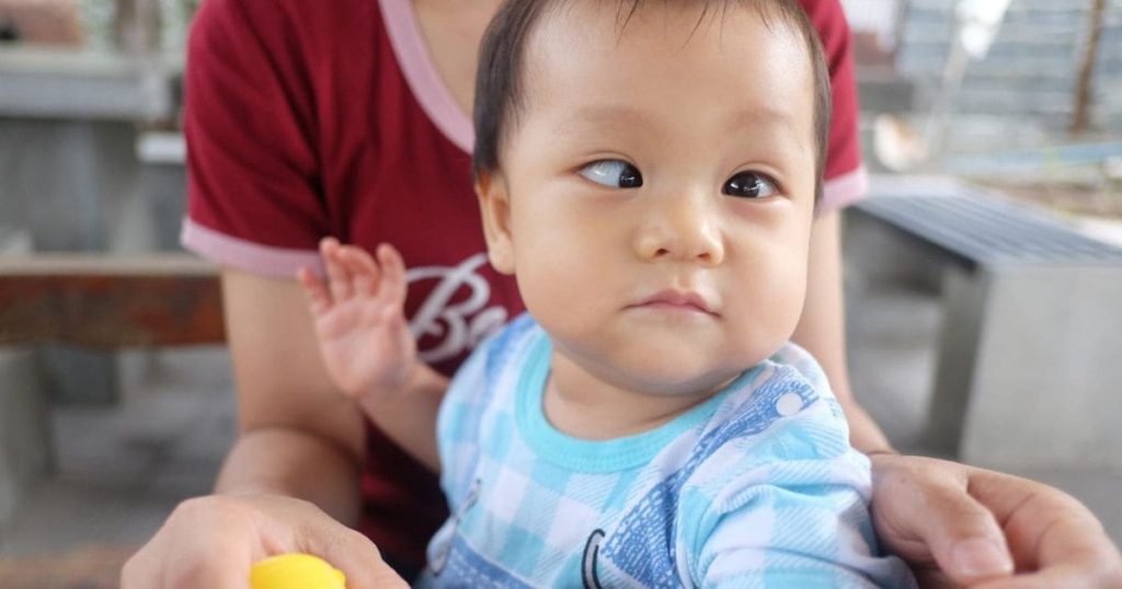 Đục thuỷ tinh thể có thể khiến bé bị lác mắt
