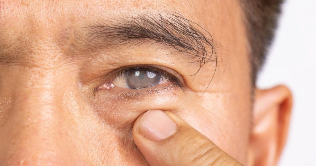 Đục thủy tinh thể khiến người bệnh khó khăn trong sinh hoạt hằng ngày