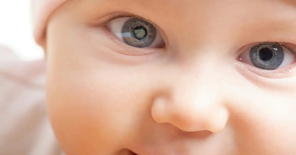 Em bé có thể bị đục thuỷ tinh thể từ khi sinh ra