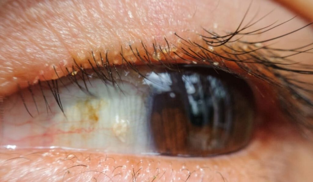 Giữ vệ sinh đúng cách để bảo vệ mắt