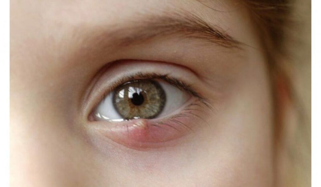 Hãy đến các cơ sở y tế chuyên khoa để được loại bỏ mụn đúng cách và an toàn
