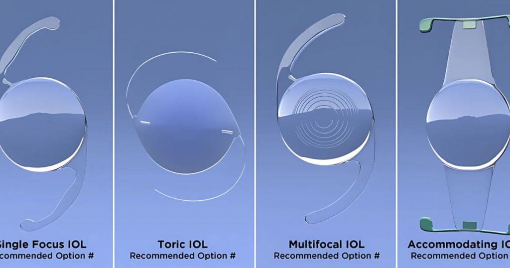 IOL Toric có hiệu quả cao trong việc điều trị loạn thị
