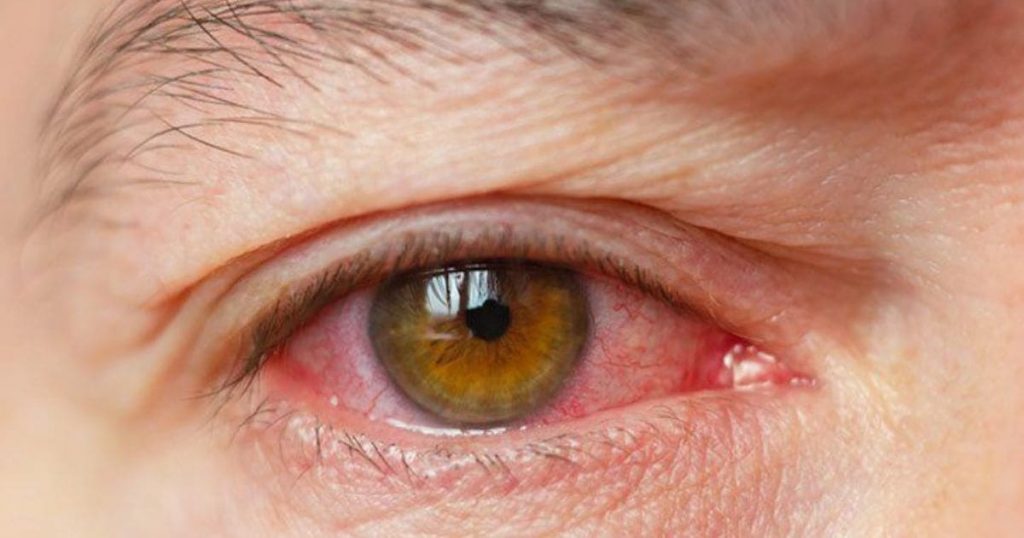 Khô mắt là hiện tượng thường gặp sau khi phẫu thuật LASIK