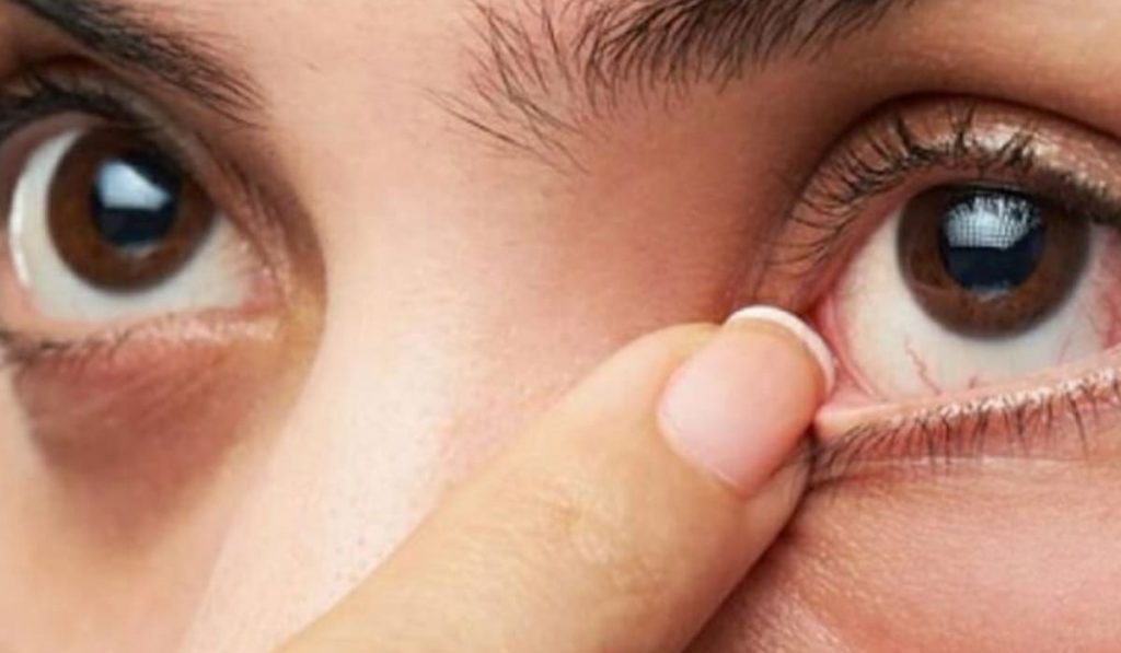 Mắt có chấm trắng ở lòng đen rất có thể là dấu hiệu viêm loét giác mạc