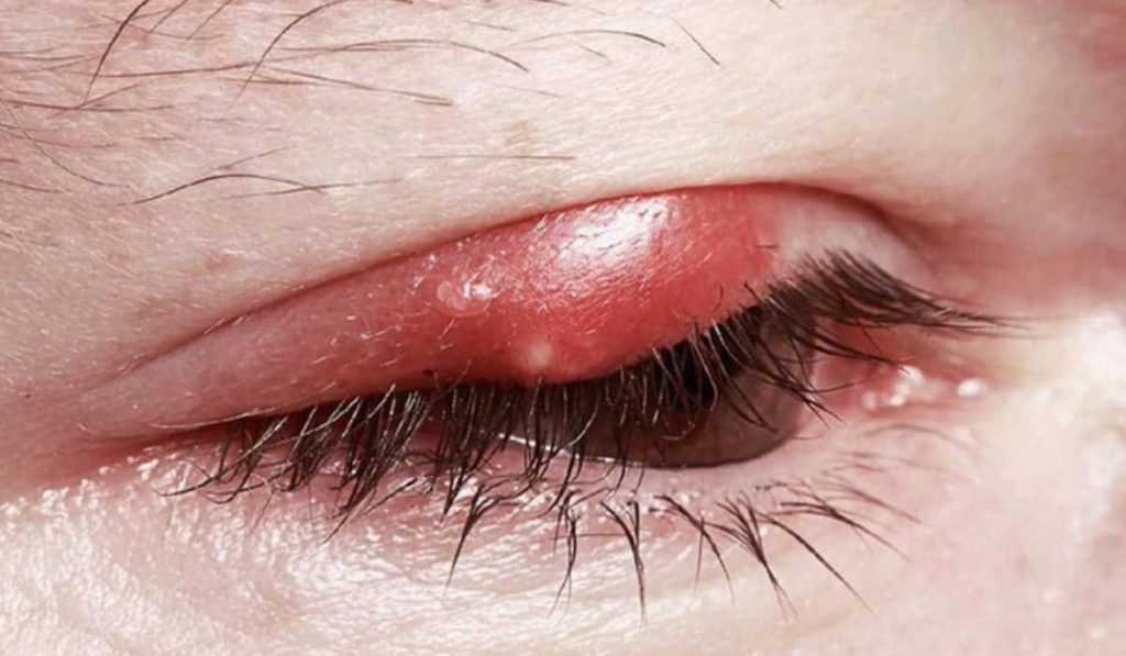 Mi mắt trên nổi một nốt mụn trắng, gây cộm và đau nhức khó chịu