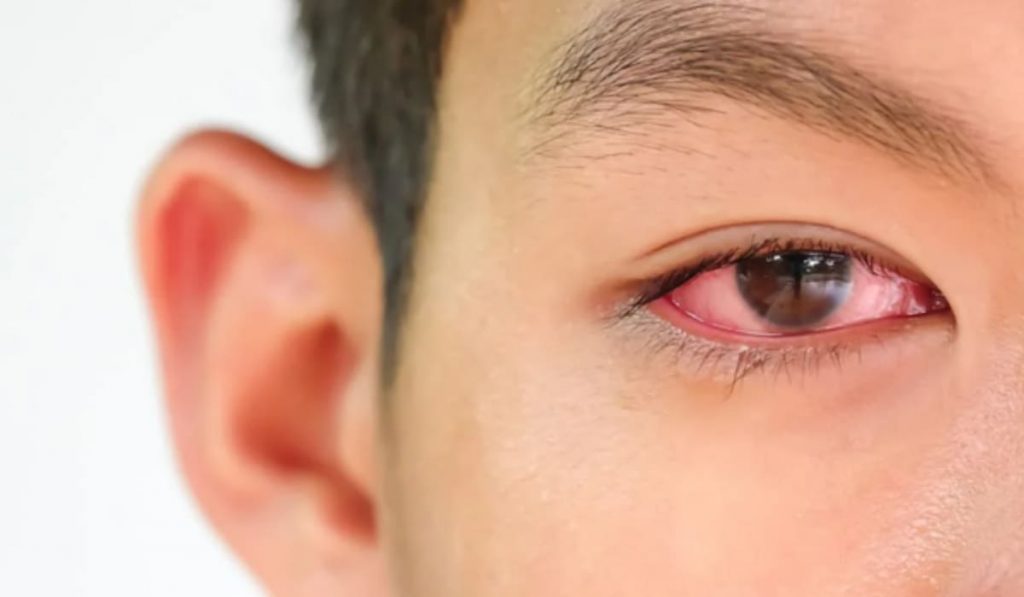 Nên giữ khoảng cách với người mắc đau mắt đỏ để bảo vệ mắt của bạn