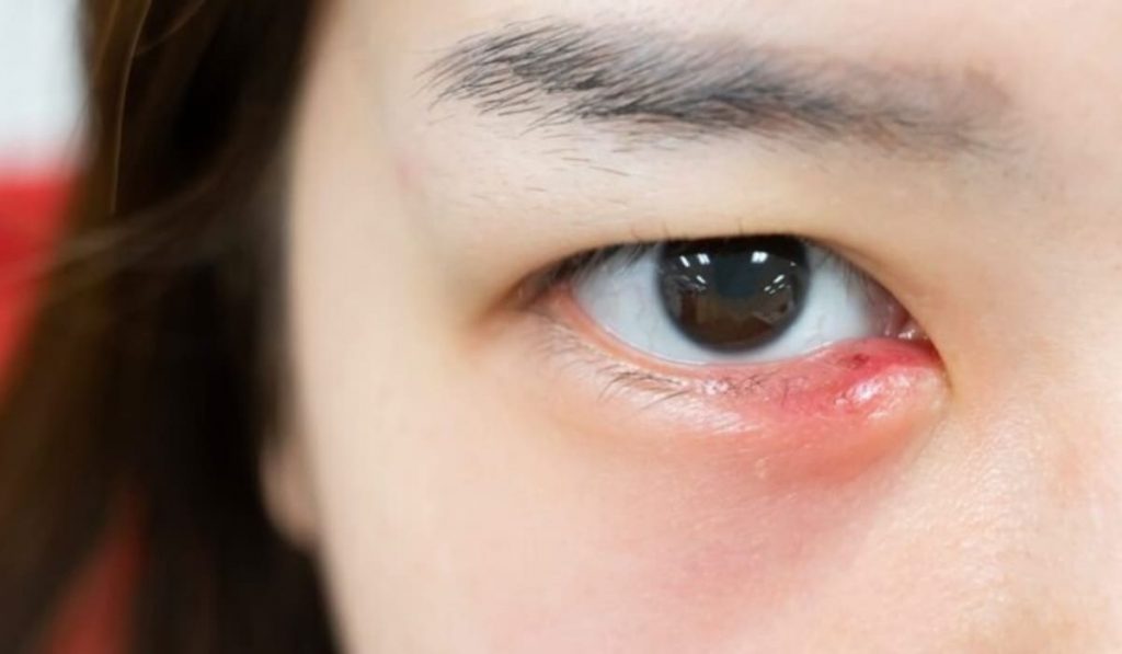 Sưng đỏ ở mi mắt là một trong những dấu hiệu chính của lẹo mắt