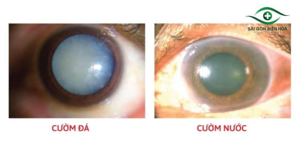 Triệu chứng cườm khô và cườm nước không giống nhau