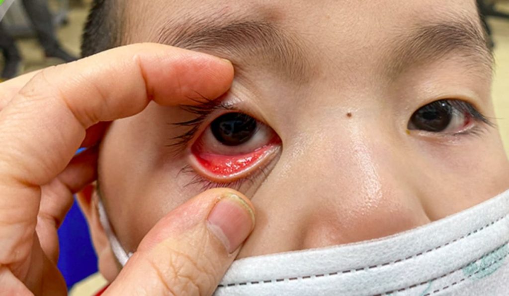 Viêm kết mạc và đau mắt đỏ là cùng một bệnh, gây đỏ và ngứa mắt