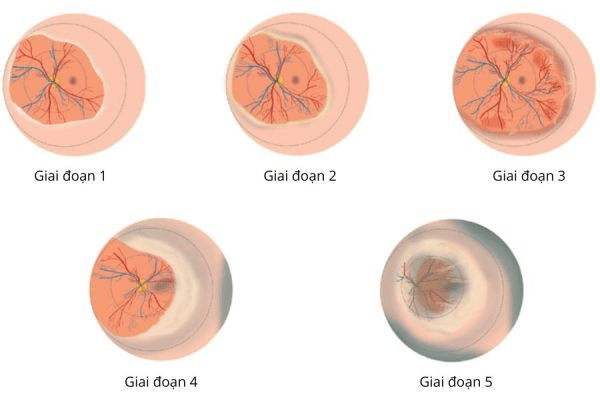 5 giai đoạn phát triển của bệnh võng mạc ở trẻ nhỏ
