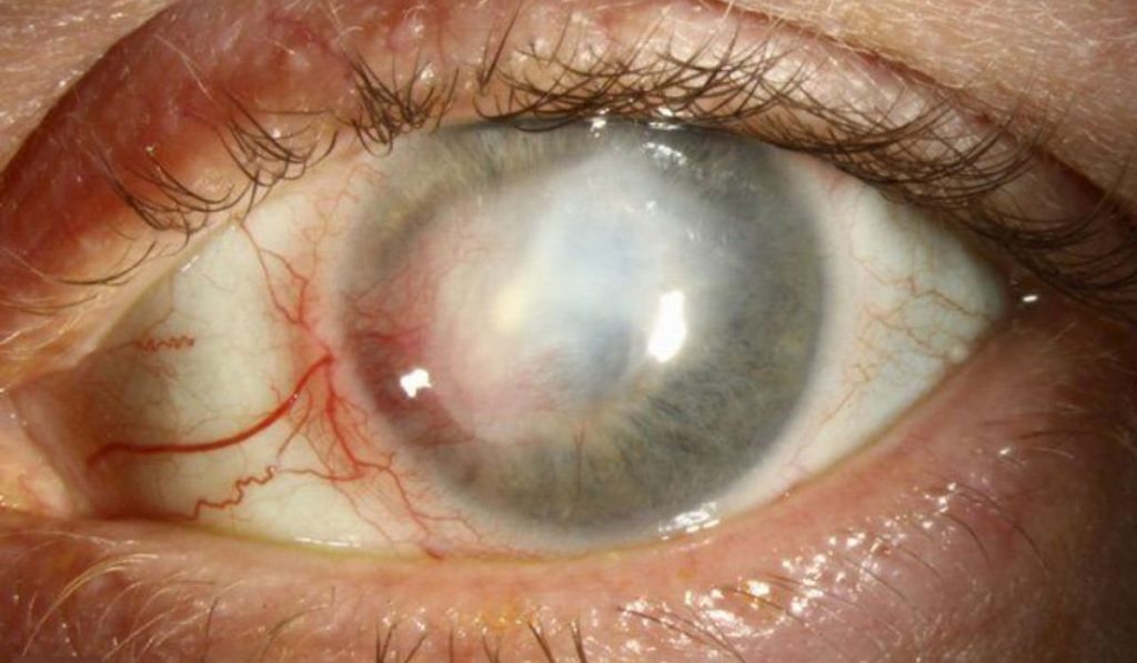 Cận cảnh mắt người với giác mạc bị tổn thương do viêm giác mạc do virus herpes