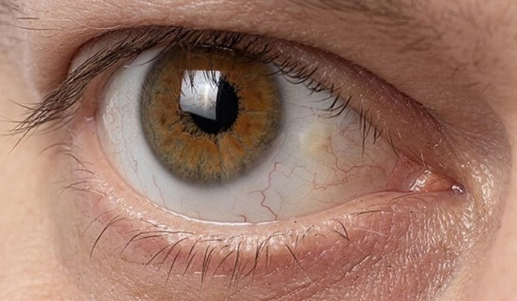 Đốm vàng do mộng mỡ thường xuất phát từ tia UV, gió bụi và khô mắt