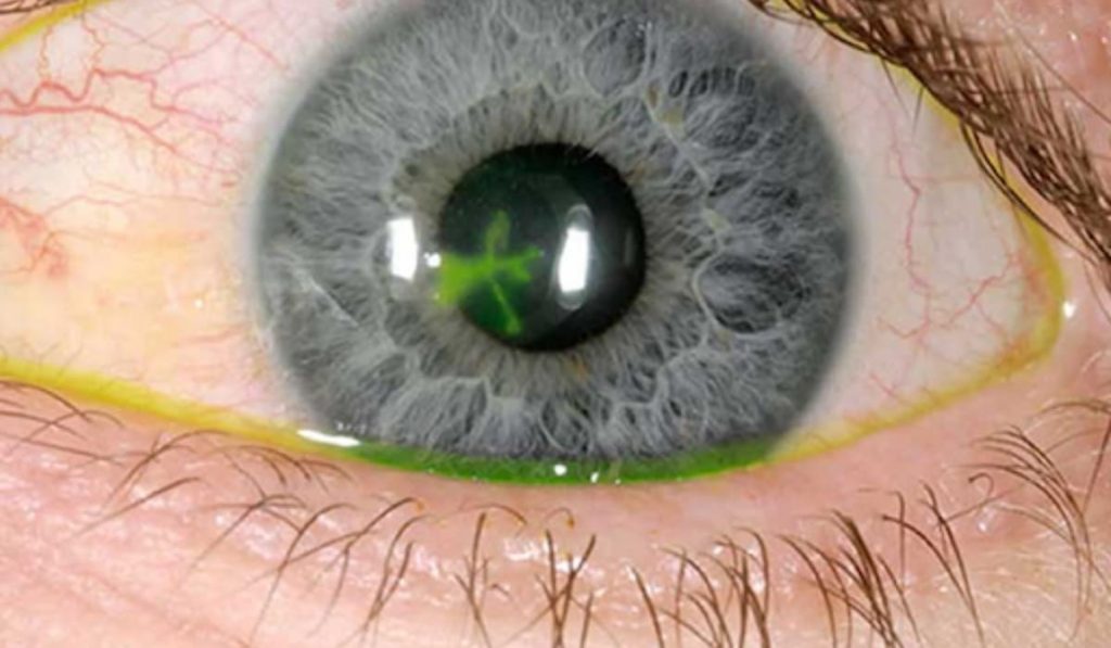 Giác mạc xuất hiện vết loét hình cành cây là đặc trưng viêm loét giác mạc do herpes