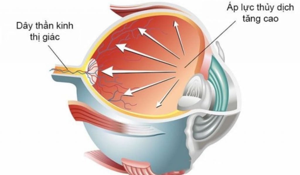 Hình thể hiện tình trạng áp lực thủy dịch dồn ép lên dây thần kinh thị giác, nguyên nhân chính gây Glaucoma