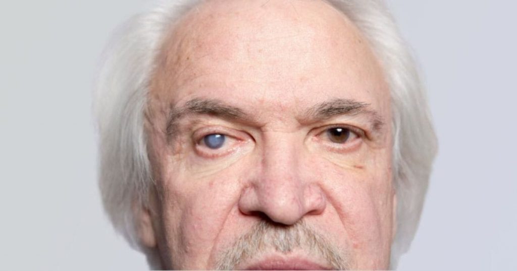 Khả năng bạn bị đục thủy tinh thể sẽ cao hơn nếu trong gia đình có người mắc bệnh