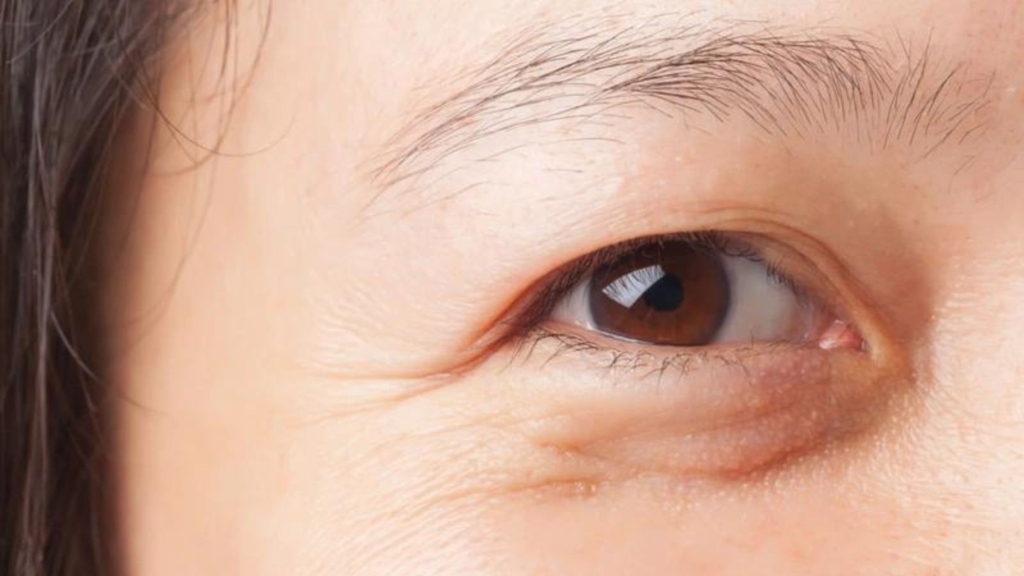 Lão hoá mắt có thể là một trong những nguyên nhân dẫn đến bong võng mạc