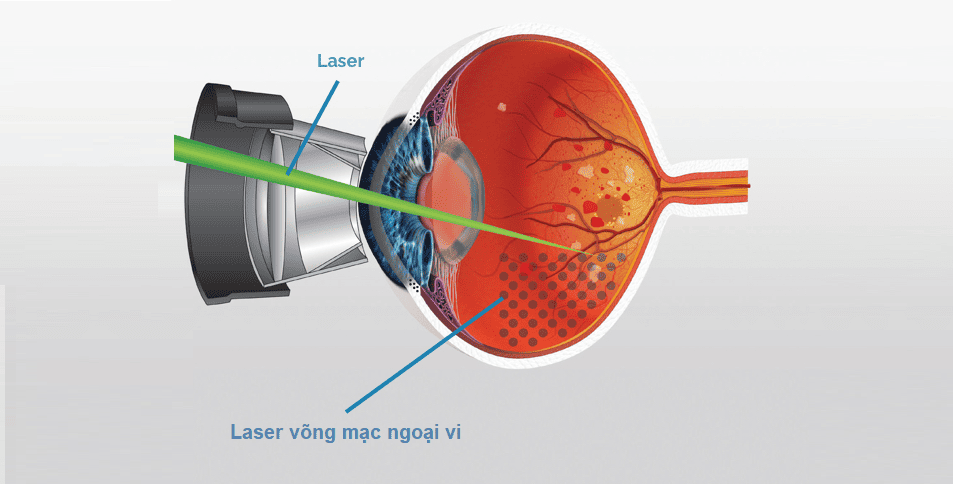 Laser quang đông ngăn chặn kịp thời quá trình phát triển bong võng mạc