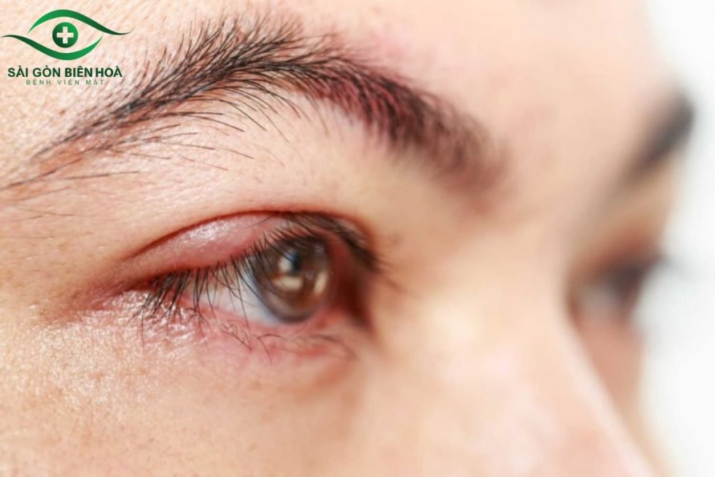 Lệch thuỷ tinh thể có thể dẫn đến viêm nhiễm mắt kéo dài