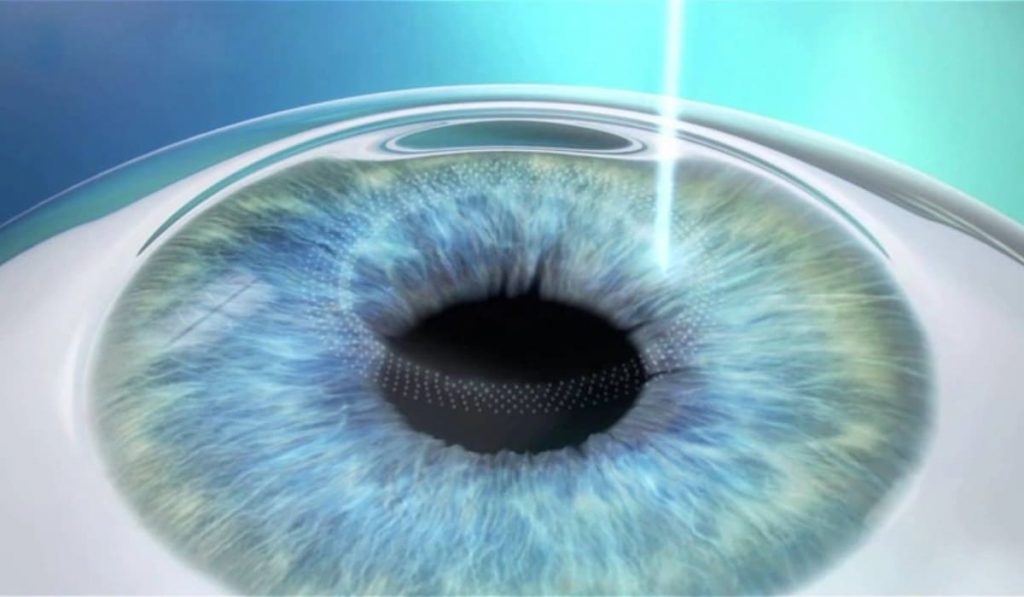 Lenticule là lớp mô giác mạc mỏng hình thấu kính trong phẫu thuật CLEAR