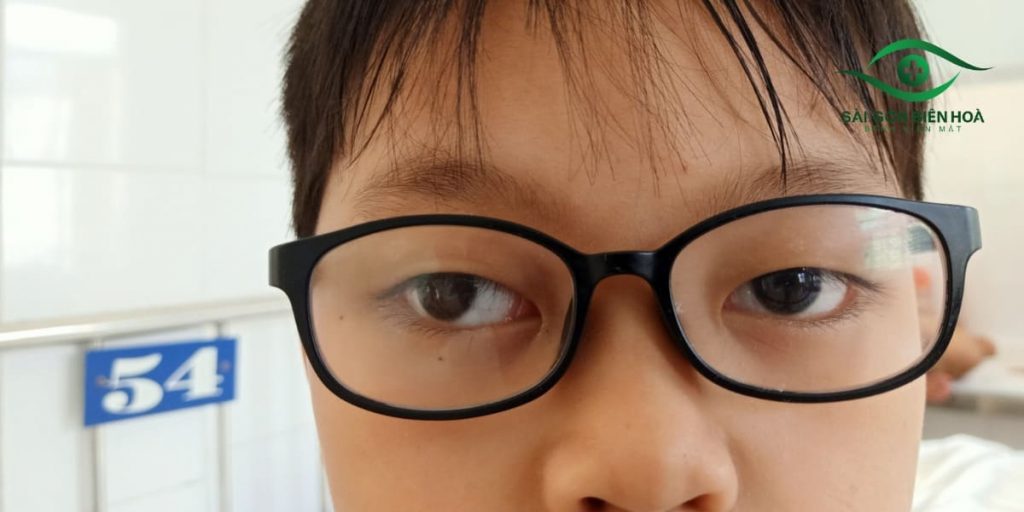 Mắt lác ngoài có lòng đen bị lệch về phía tai
