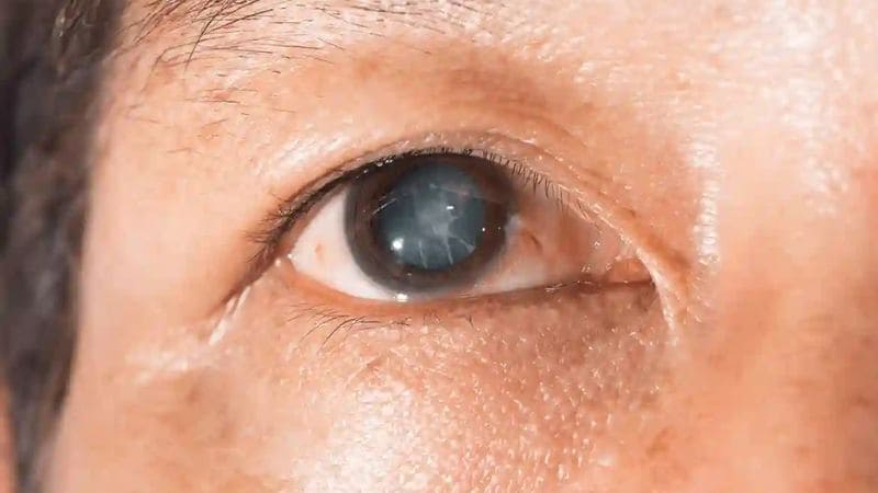Người bị đục thuỷ tinh thể nặng cần phẫu thuật mổ cườm mắt