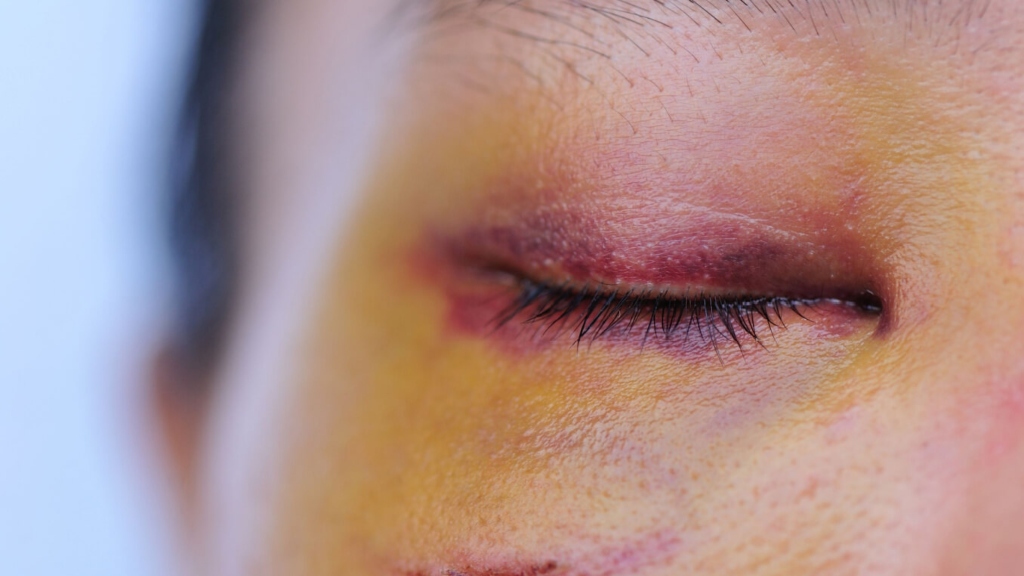 Người từng bị chấn thương mắt thường có thể dễ bị bong võng mạc kèm theo