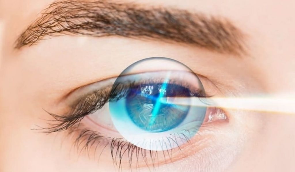 Phẫu thuật CLEAR với lenticule phù hợp cho người cận, loạn thị và có giác mạc khỏe mạnh