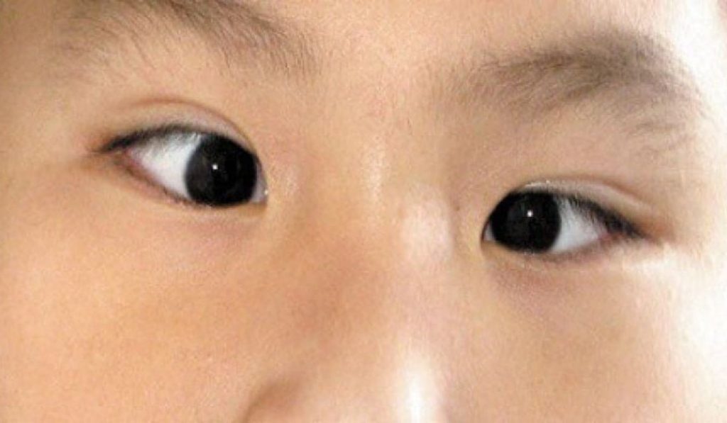 Phẫu thuật mắt lác lé