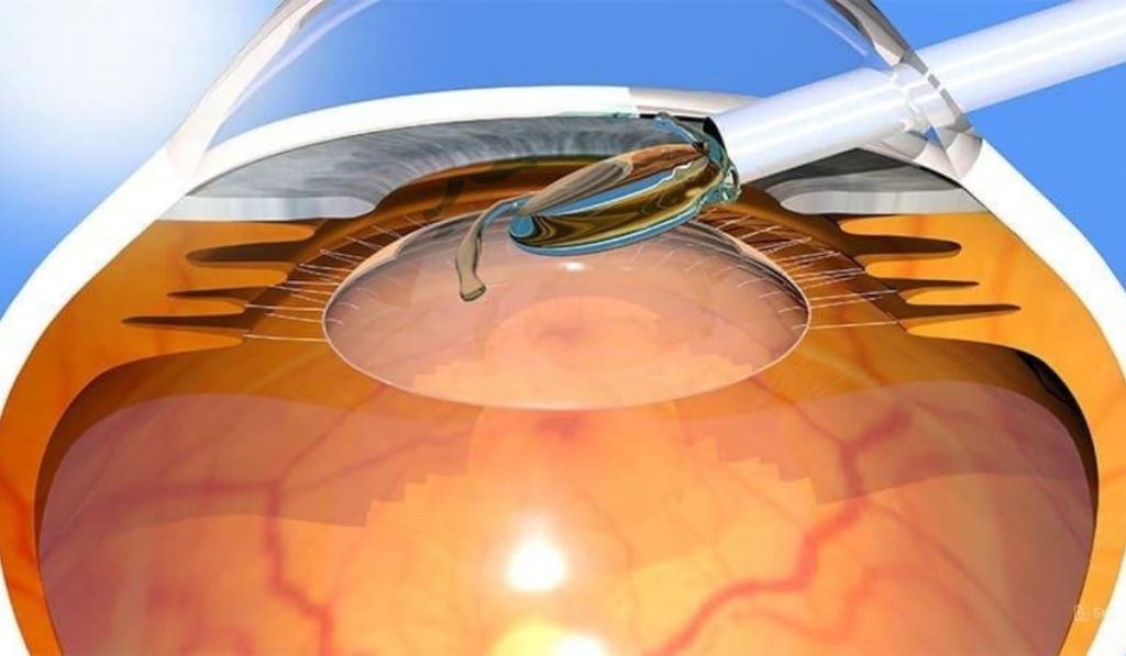 Phẫu thuật Phaco là bác sĩ rạch vết mổ nhỏ và dùng sóng siêu âm hút bỏ thủy tinh thể đục