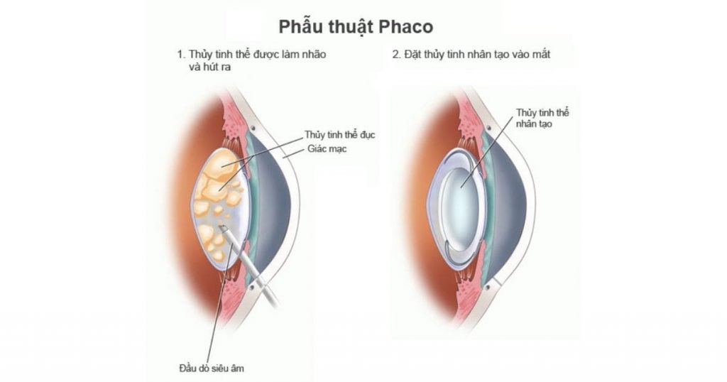 Phẫu thuật Phaco là phương án tối ưu, an toàn và hiệu quả trong việc thay thủy tinh thể