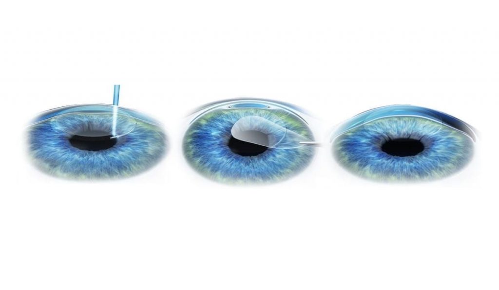 Quy trình CLEAR với lenticule: tạo – rút – hồi phục nhanh, an toàn và ít xâm lấn