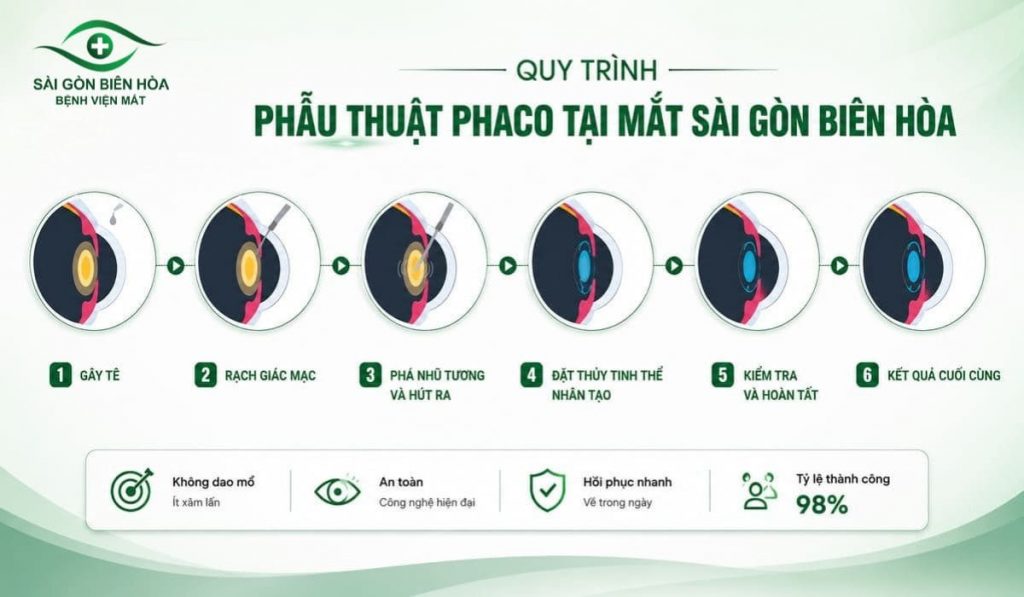 Sơ đồ mô phỏng kỹ thuật nhũ tương hóa thủy tinh thể (Phacoemulsification)