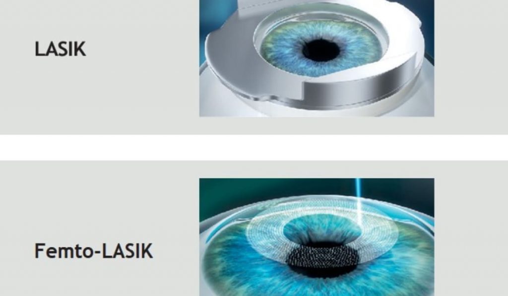 Sự khác biệt giữa LASIK và Femto-LASIK