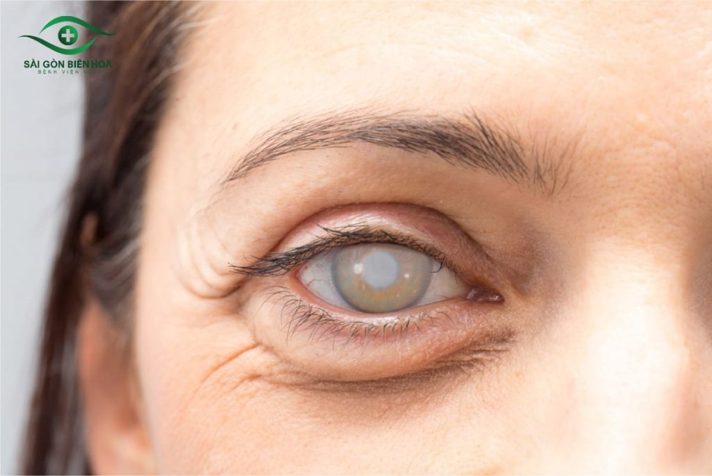 Thuỷ tinh thể trượt hẳn khỏi vị trí ban đầu