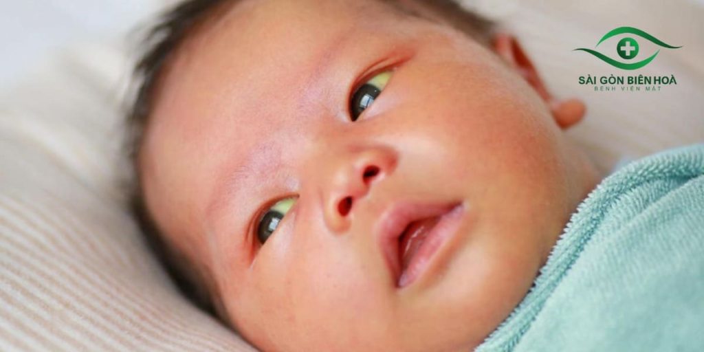 Trẻ có thể bị lác ngay khi chào đời